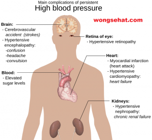 Cara Mengatasi Tekanan Darah Tinggi atau Hipertensi
